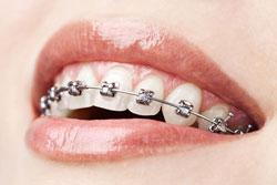 Northvale NJ Orthodontist Braces