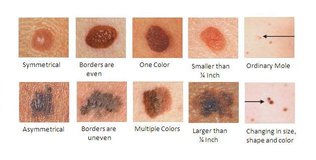 Skin Cancer Check Table