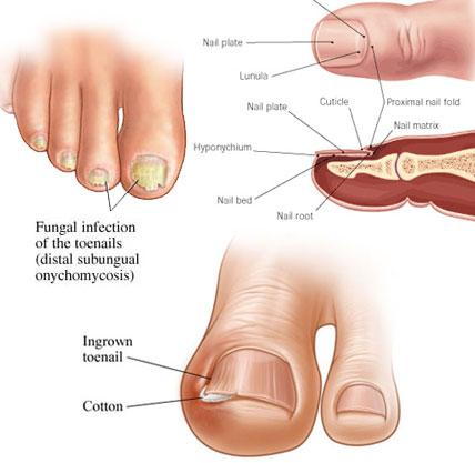 What is the treatment for a toe nail fungal infection where some part of  the nail has come off and some remains attached to the nail bed? - Quora
