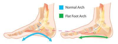 What is Adult Flatfoot?