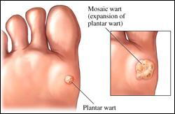 Plantar Wart