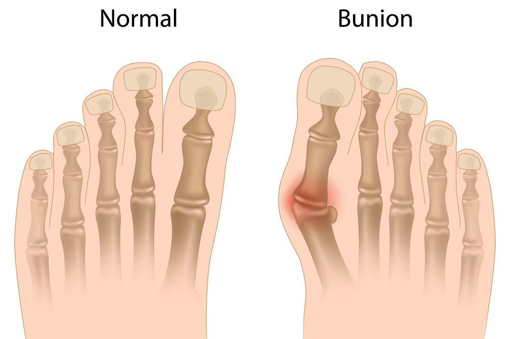 Bunion Surgery New Orleans