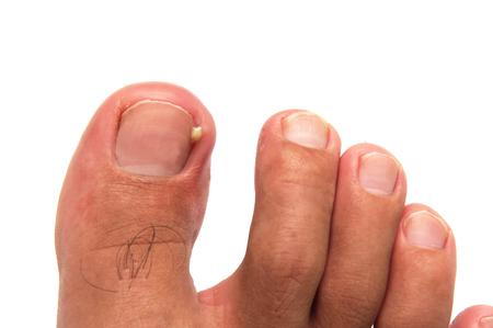 How to Identify and Address Your Toenail Problems - The Foot Doc™