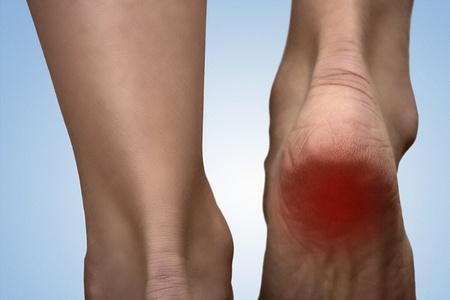 Plantar Fasciitis: Overcoming Heel and Arch Pain Naturally