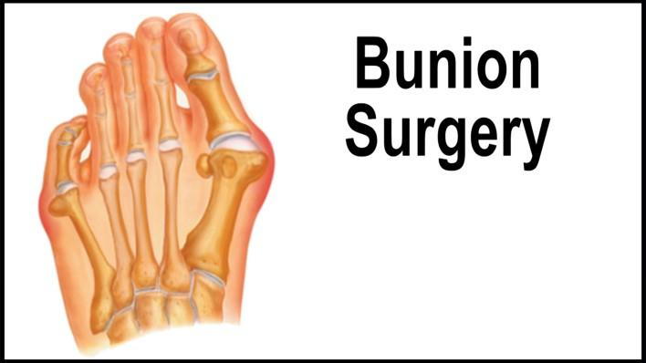 bunion surgery