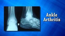 arthritis4.jpg