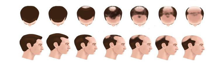 hair-loss-progress-men.png