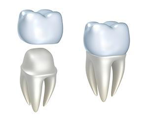 cerec crowns