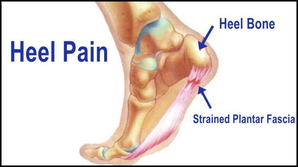 heel pain achilles tendon and plantar fasciitis
