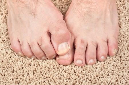 Toes Appearance After Ingrown Nail Surgery Stock Photo - Download Image Now  - Bandage, Barefoot, Blood - iStock