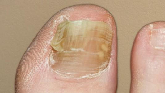 toenail-fungus3.jpg