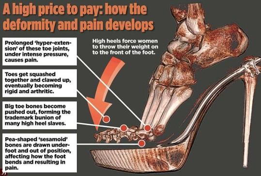 High heels cause arthritis in toes - Health - The Jakarta Post