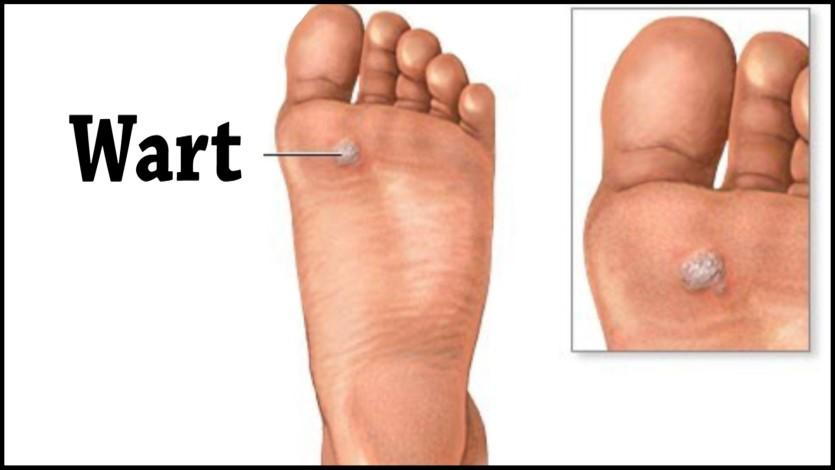 hpv foot wart treatment)