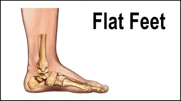 women with flat feet