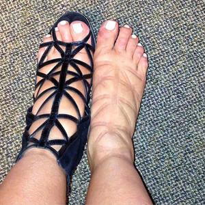 swollen heels of feet