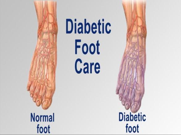 Diabetic Foot Care