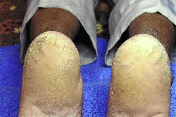Dry Skin And Cracked Heels Prevalent Among Those With Diabetes