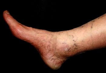 varicose foot mock ce este simptome varice ascunse
