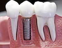 Freemont cosmetic dentistry dental implants