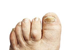 Treating Toenail Fungus