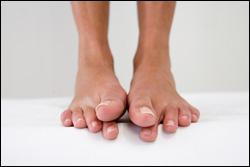 The Truth About Hammertoes