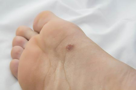 Bone Cancer: Can a Lump on Your Foot Be a Symptom?