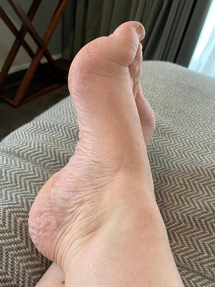 Swollen arch sale of foot