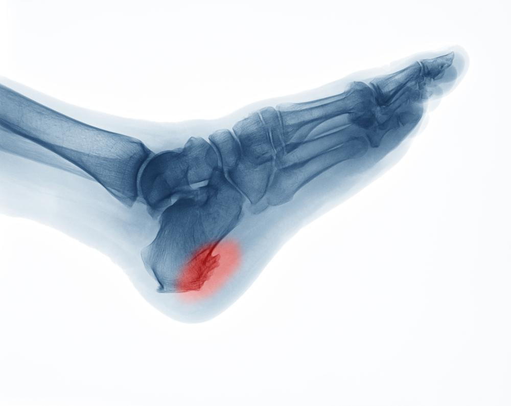 Can I Exercise With Heel Spurs? What To Do & What To Avoid