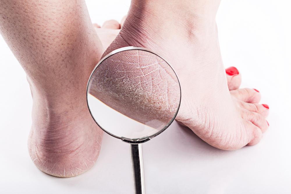 Have Cracked Heels? These 9 Home Remedies Will Solve Your Problem! |  HerZindagi
