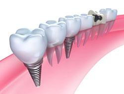 Dental Implants Replace Missing Teeth