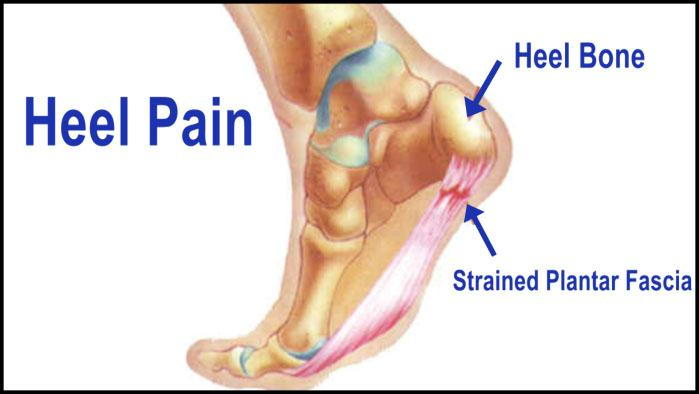 Plantar Fasciitis: A Painful Heel - Hughston Clinic