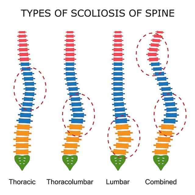 Female Scoliosis Degrees Of Curvature Chart