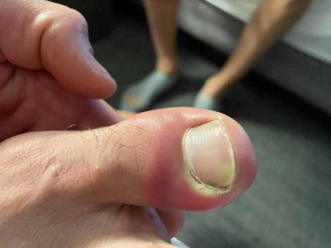 infected ingrown toenails