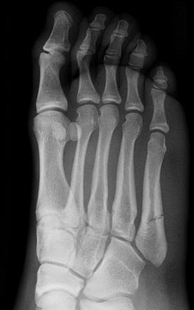Lateral foot Injuries: Sprains, Fractures, and Nutcrackers