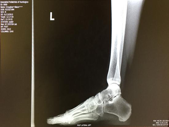 Ankle Sprain X-Ray 2