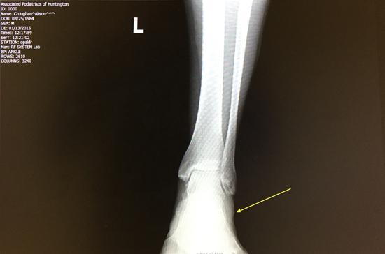 Ankle Sprain X-Ray 1