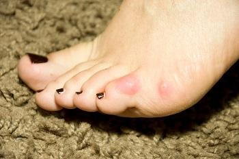 Blog - Causes,Prevention & Treatment of Corn Calluses