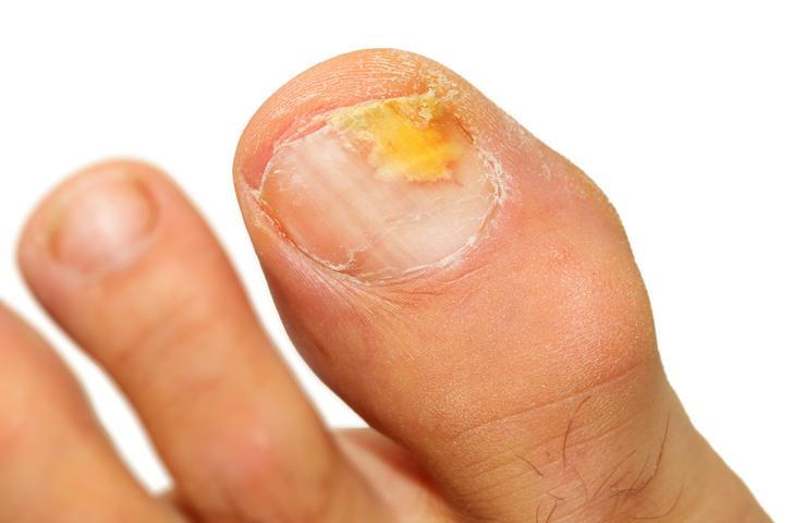 Onychomycosis