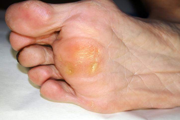 Corn Lesion On Foot Sale | emergencydentistry.com