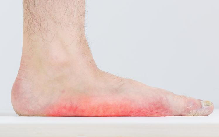 Flat Feet: 5 Different Types of Surgery