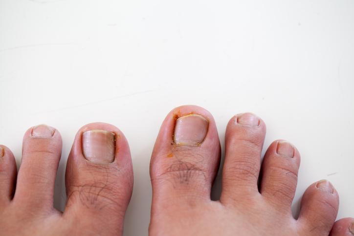 Toenail surgery | Exeter Physio