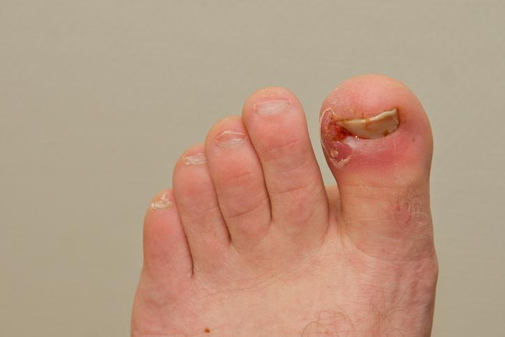 Why Does This Ingrown Toenail Keep Coming Back? — Precision Foot