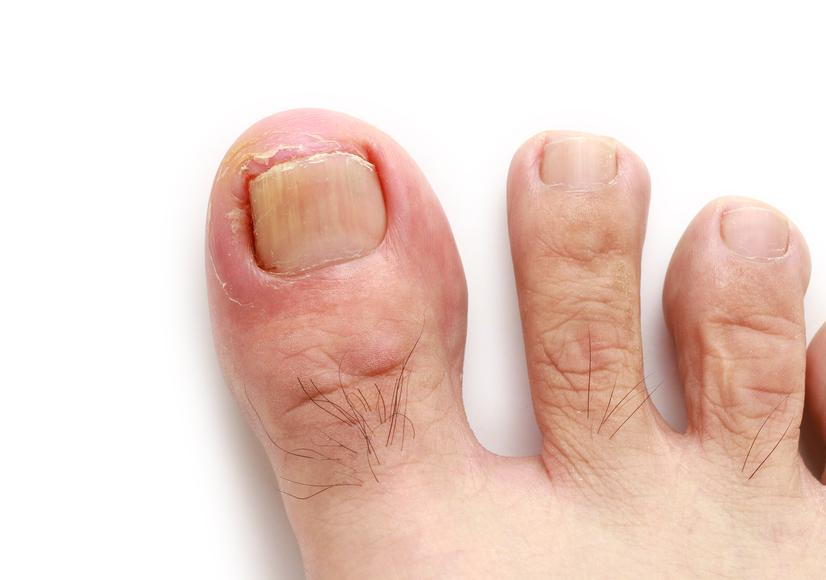 Podiatry Ingrown Toenail | Round House Podiatry