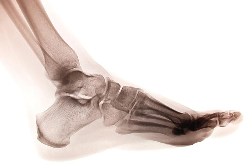 Where Do Bone Spurs Occur In My Feet?