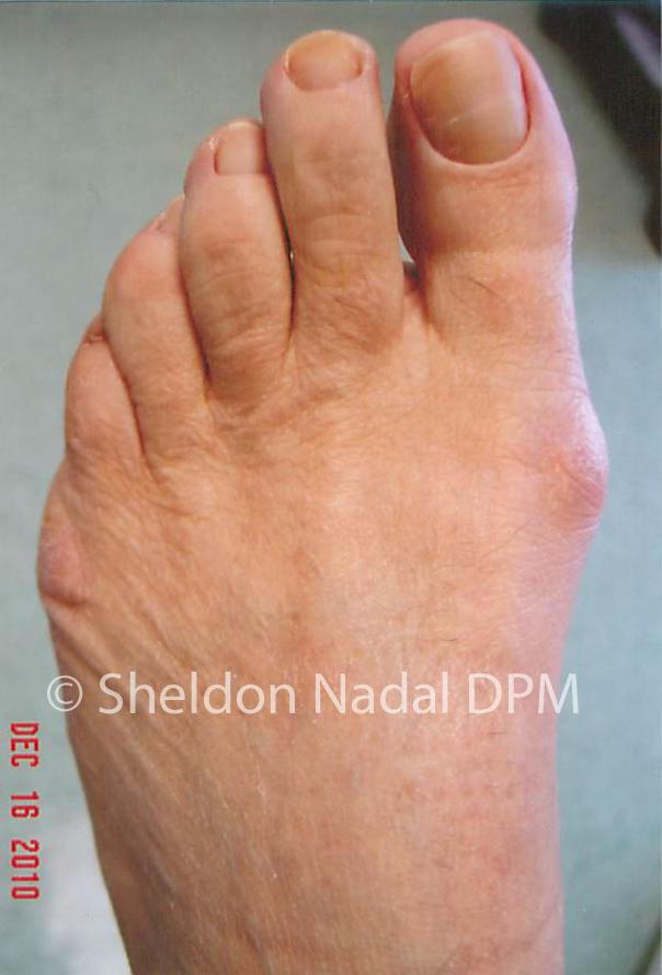 tailors bunion surgery before and after