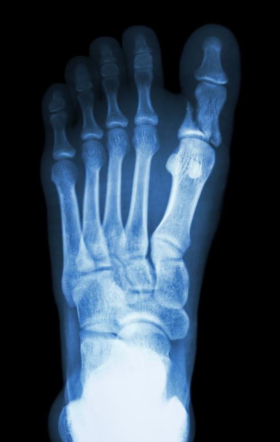 Metatarsal on sale bone spur