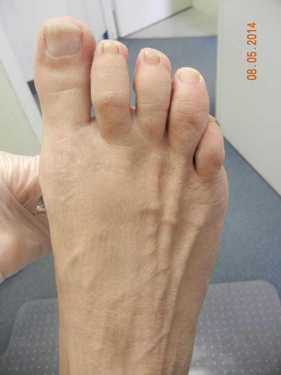 minimally-invasive-bunion-surgery-for-50-year-old-toronto-woman