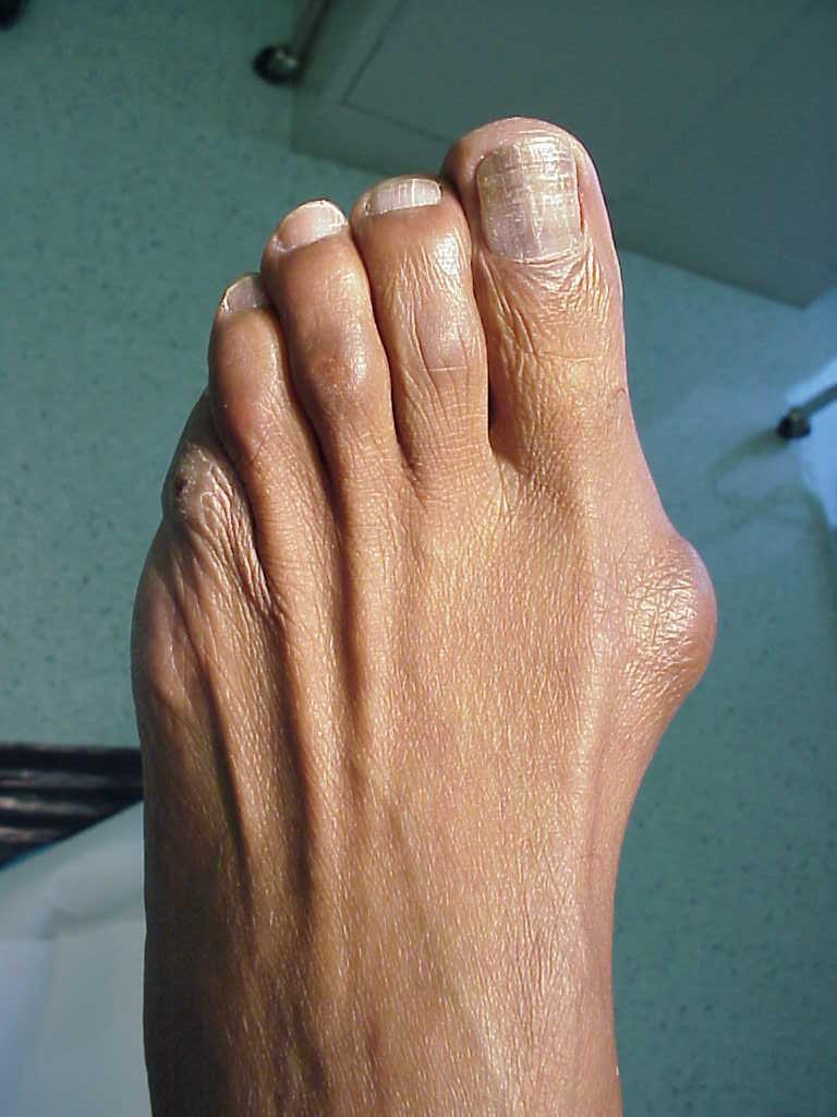 What Are Hammer Toes? Information From a Foot Doctor: Leonard