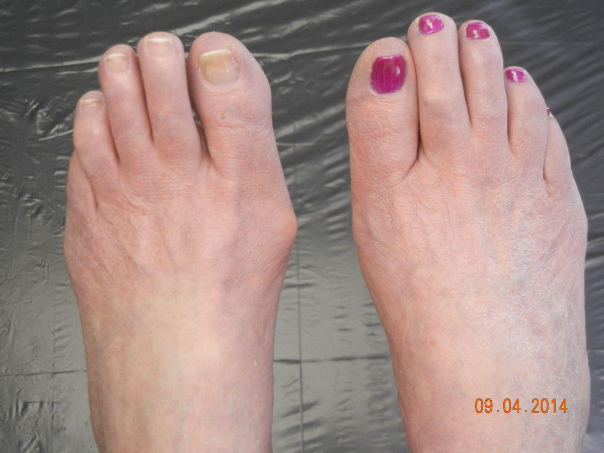 Pretty feet with bunions