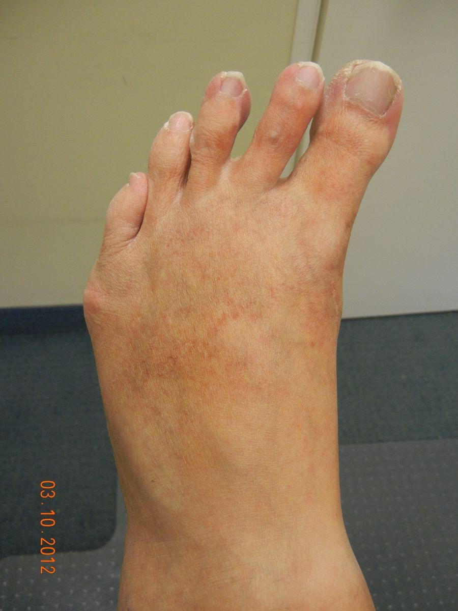 hallux varus